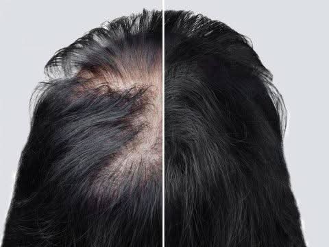 Dermastamp for Hair Regrowth – Microneedling ToolThe Hair Fuel