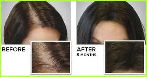 Dermastamp for Hair Regrowth – Microneedling ToolThe Hair Fuel