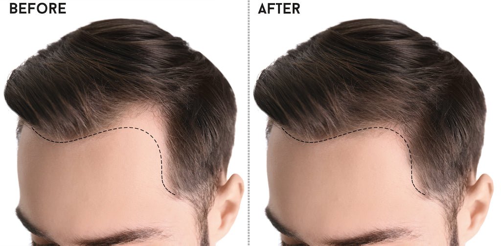 Dermastamp Hairline: Unlocking the Secret to Fuller, Thicker Hair - The Hair Fuel