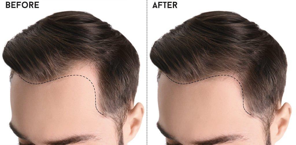 Dermastamp Hairline: Unlocking the Secret to Fuller, Thicker Hair - The Hair Fuel