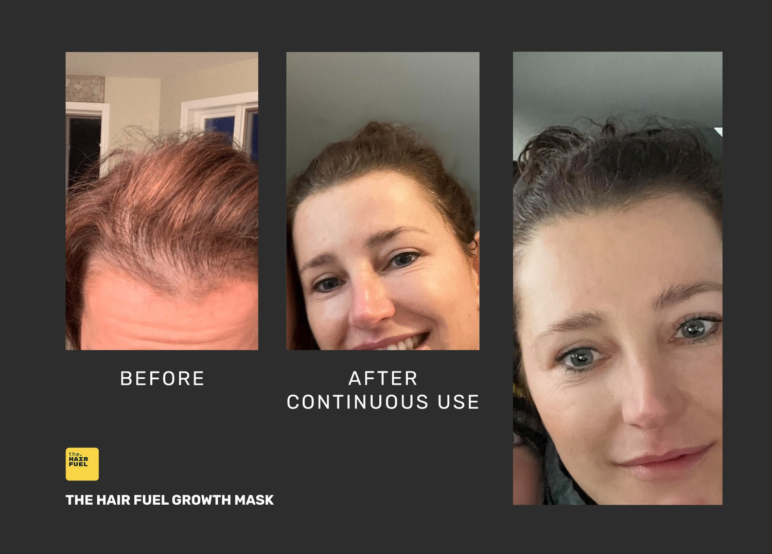 Hair growth success story: Karine - The Hair Fuel