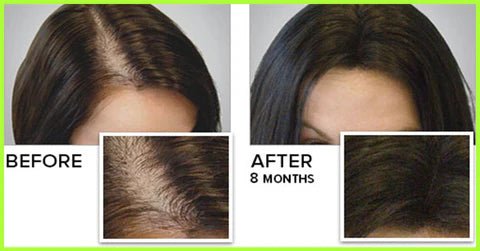 Derma Stamp for Hair Growth - The Hair Fuel