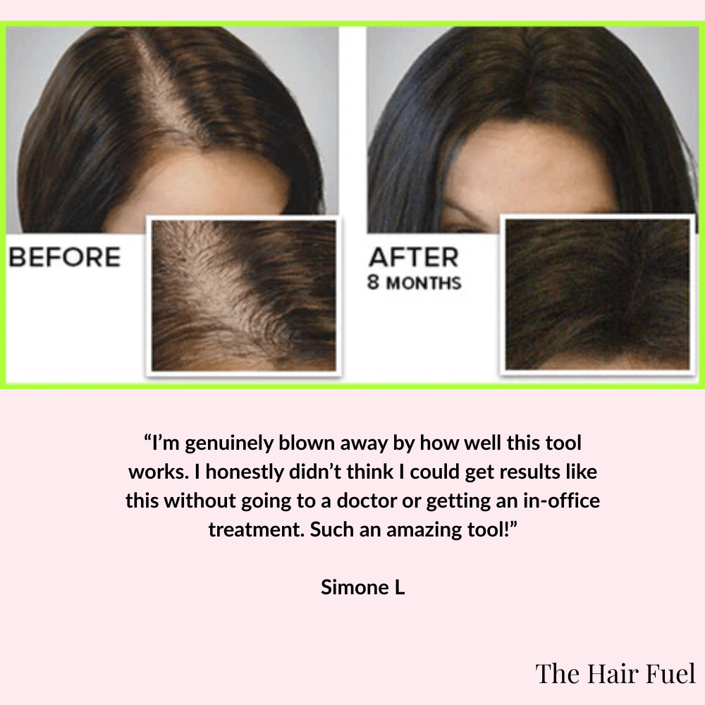 Derma Stamp for Hair Growth &amp; Scalp MicroneedlingThe Hair Fuel